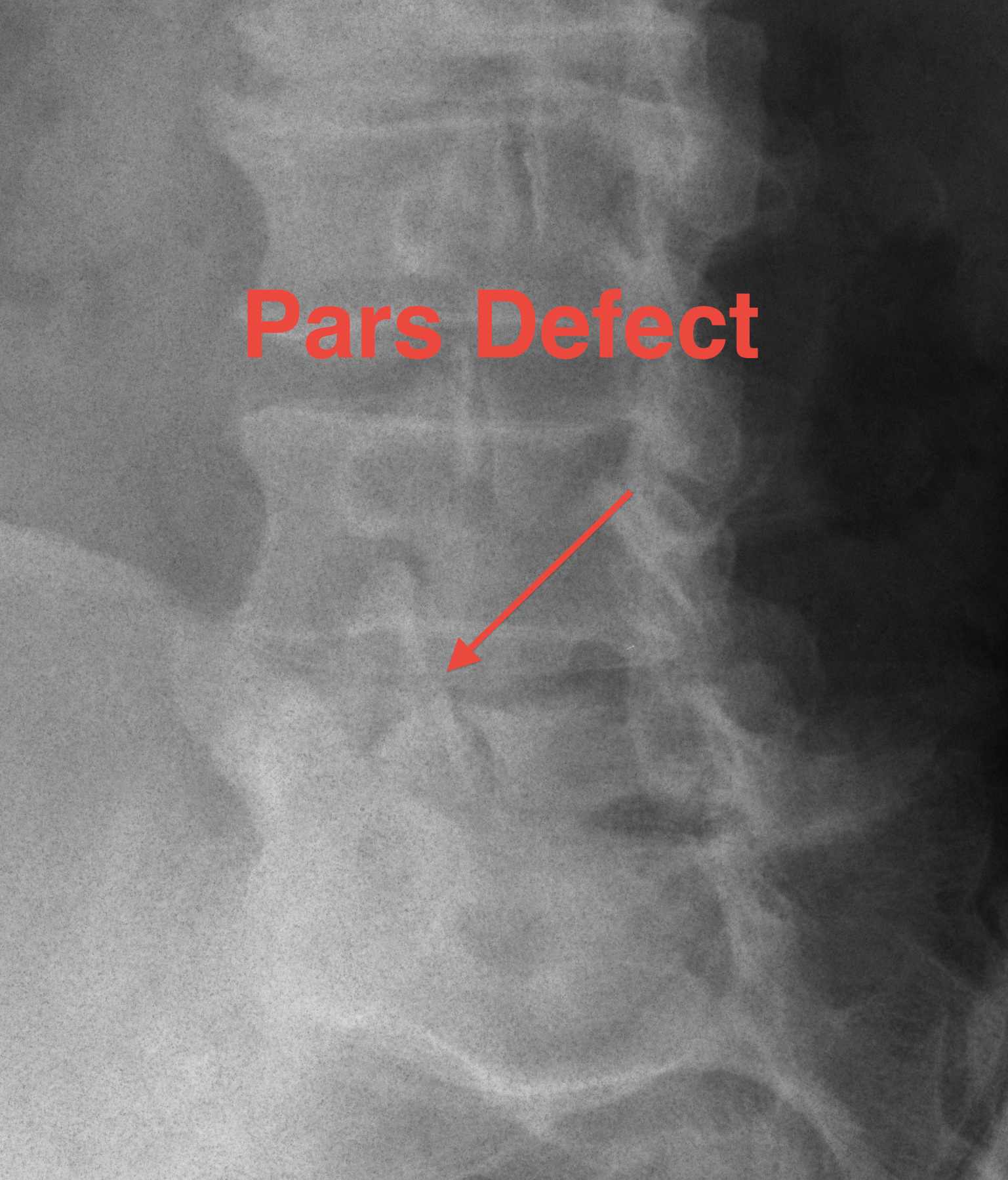 Pars Defect Oblique Xray